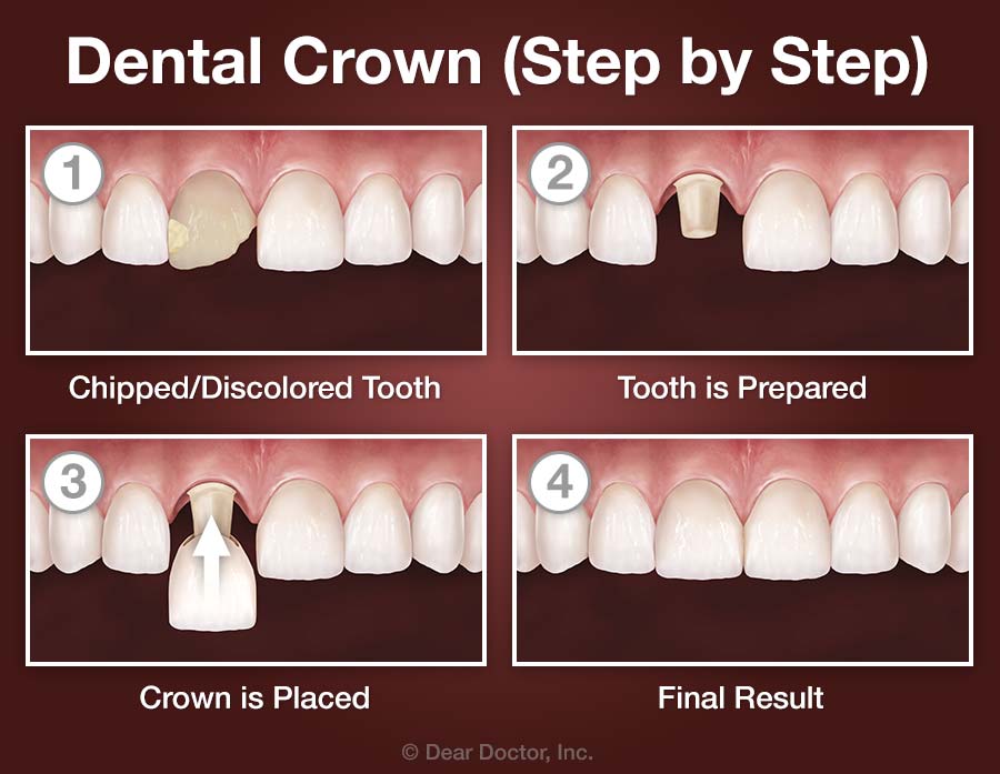 Dental Crowns - Step by Step.