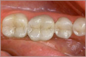 Fillings_A