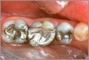 Fillings_B