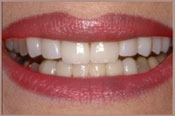 Veneers_A
