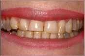 Veneers_B